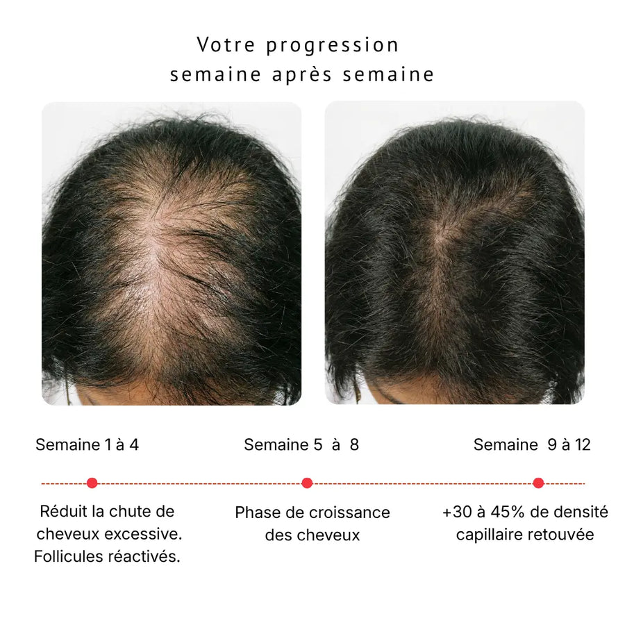 Post partum - Casquette LED Douciane - Anti-chute et repousse cheveux